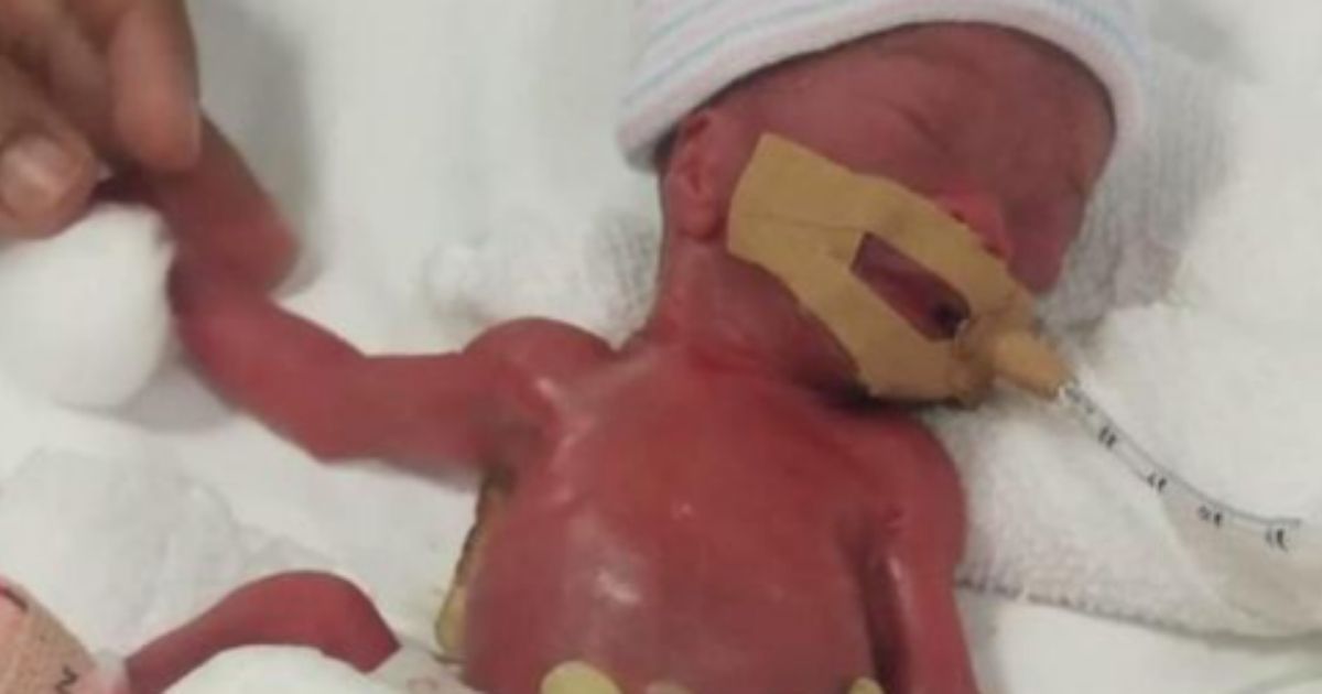 'World's Smallest Known Baby' Born the Weight of an Apple Finally Goes Home After 13 Months in Hospital