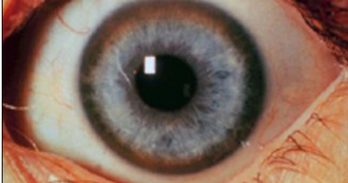 Man Develops Copper Rings in His Eyes, Then Doctors Discover the Rare Condition – 'Wilson's Disease'