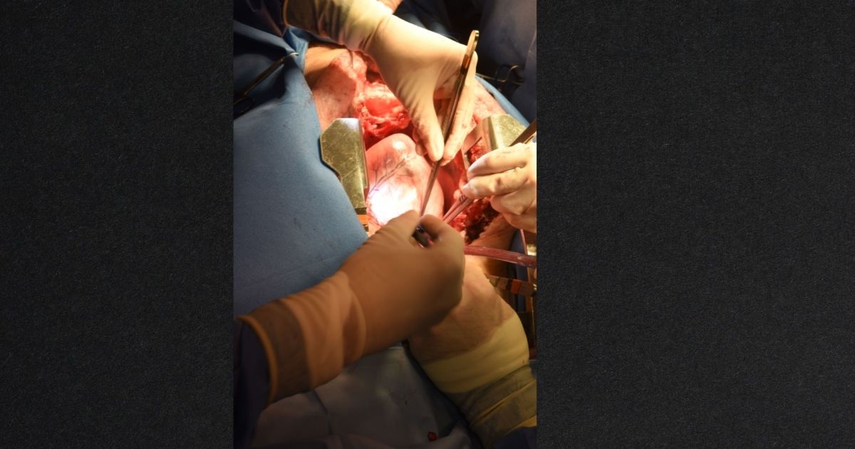 Patient Survives After Doctors' Hail Mary Procedure Gives Him an Animal Heart: 'We Are Trying to Make Sense of It'