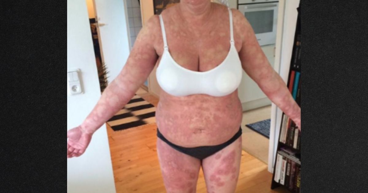 Mother Suffers From Rash After Becoming Pregnant: 'It Was Like I Was Allergic To My Own Baby'
